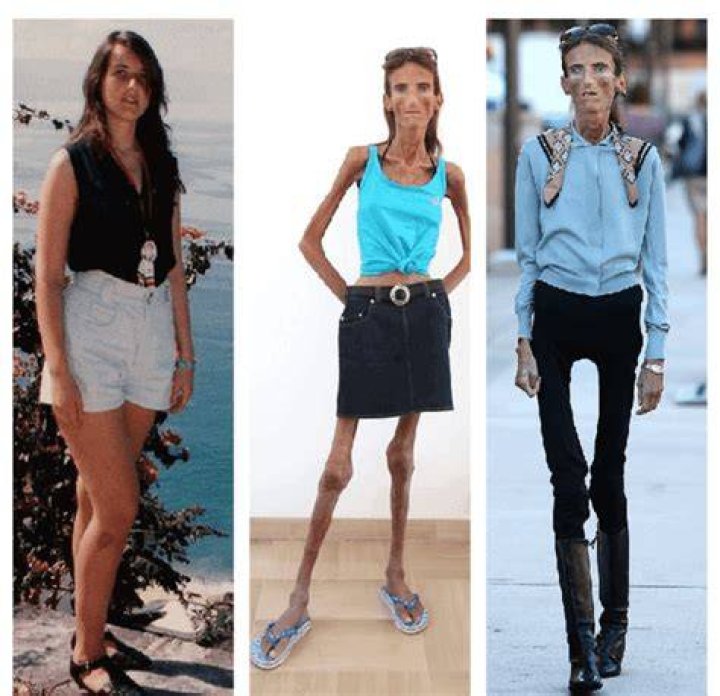 Discovering the World's Skinniest Person: A Fascinating Journey
