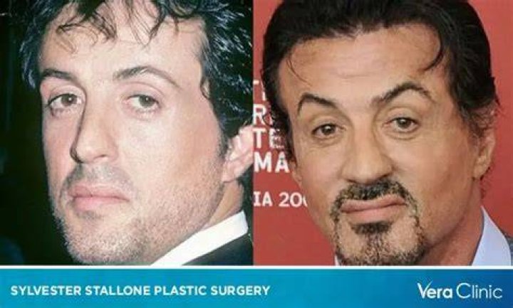 Has Sylvester Stallone Had a Stroke? Exploring the Facts and Myths