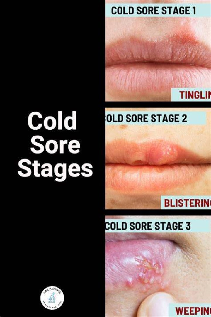 Should I Pop a Cold Sore? Everything You Need to Know